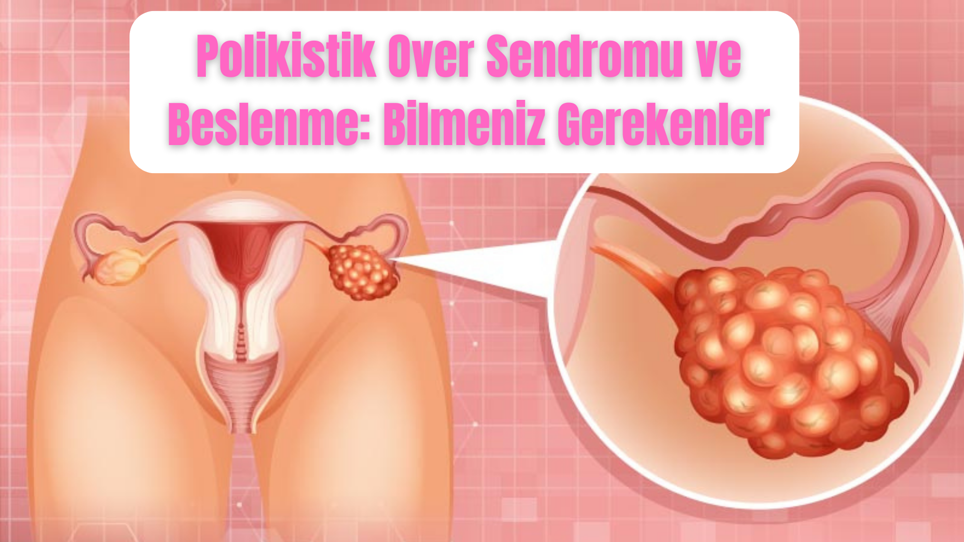 Polikistik Over Sendromu ve Beslenme